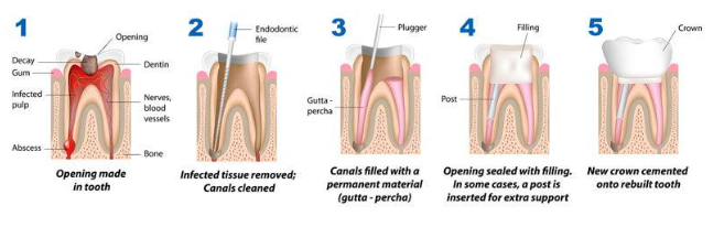 ROOT CANAL image